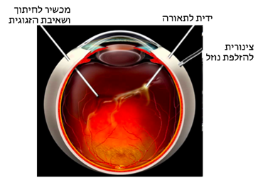ניתוח ויטרקטומיה: נראים שלושת הפתחים המבוצעים בדופן העין והמכשירים המוחדרים דרכם לעין. הניתוח מבוצע לרוב בהרדמה מקומית ואינו כרוך בכאבים